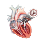aortic regurgitation
