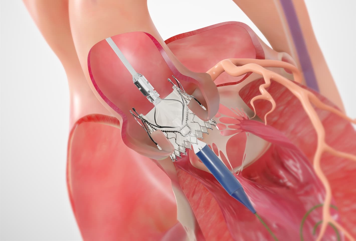 Trilogy System illustration